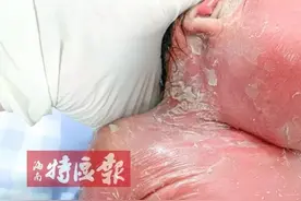 心疼！女婴刚出生就满身“鱼鳞”，皮肤干枯如老人…图片