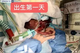 出生体重仅500克“巴掌宝宝”康复出院图片