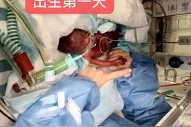 出生体重仅500克“巴掌宝宝”康复出院图片