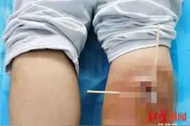 成都男子被蚊虫咬伤后，腿部出现“大洞”！医生提醒：这不是小事图片