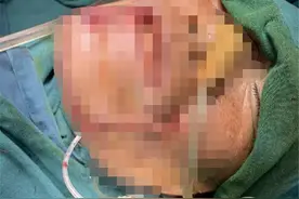 牙齿咬电线！男子被220V电“打脸”大半个“下颌”没了图片