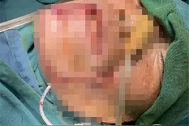 牙齿咬电线！男子被220V电“打脸”大半个“下颌”没了图片