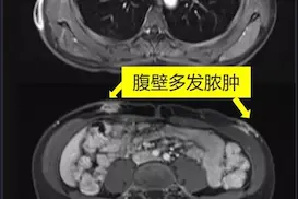 “埋线瘦身”术后感染神秘细菌，多发脓肿安了家图片