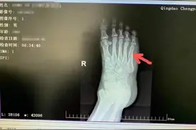 打破传统 骨折患者不需二次手术取钢板图片