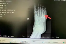打破传统 骨折患者不需二次手术取钢板图片