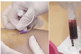 戈谢病、庞贝病、法布雷病…… 这些罕见病可以高危筛查了图片