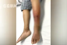 男子雨后蹚水上班结果中“毒”了 医生：严重可致命图片