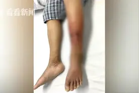 珠海男子雨后蹚水上班惹“毒”上身，医生：严重可致命图片