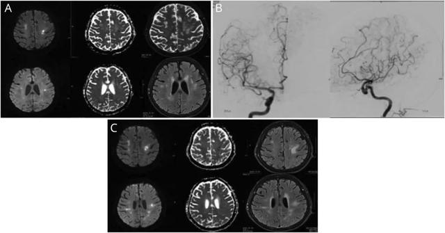 这例卒中患者，脑血管为何出现串珠样改变？丨临床推理