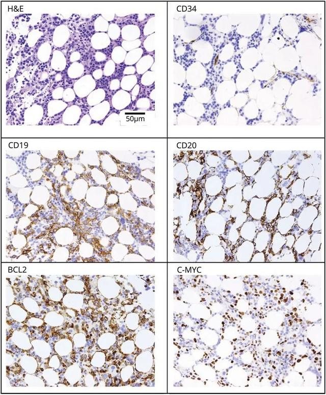 这例卒中患者，脑血管为何出现串珠样改变？丨临床推理