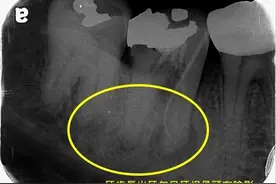 别以为抽过神经就没事？　１名女子牙齿根管细菌滋生而长牙包图片