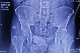 兰大二院骨科利用骨科人工智能机器人完成省内首例股骨颈骨折FNS内固定术图片