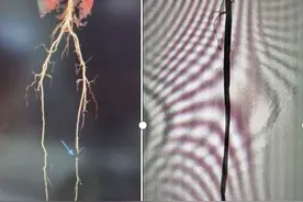腿脚变凉皮肤溃烂要截肢？介入治疗解难题图片