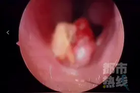 西安一6岁女童鼻子里“长牙”，取出后发现竟是三年前失踪的门牙......图片