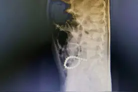 成都3岁孩子无故腹痛不止“罪魁祸首”竟是22颗磁力珠图片