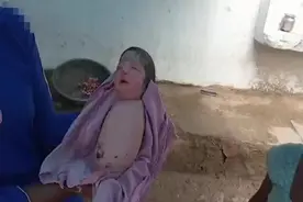 印度一名新生女婴患罕见遗传病 出生时四肢缺失视频封面