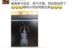 蜜汁操作！女子吃鱼卡刺，于是吞了个勺子，14厘米长图片