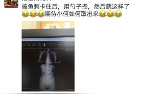 蜜汁操作！女子吃鱼卡刺，于是吞了个勺子，14厘米长图片