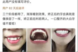 19.9元的牙套还真敢用！？24岁女生网购“整牙神器”，结果一口牙都毁了图片