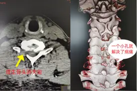 42岁老师颈肩疼痛十余年，“钥匙孔”微创手术化解顽疾图片
