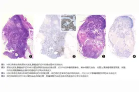 乳腺癌主要分子病理指标检测结果的解读与分析图片