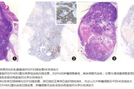 乳腺癌主要分子病理指标检测结果的解读与分析图片