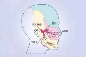 牙疼像“电击样痛”，原来是三叉神经痛图片