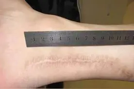 “钥匙孔”里的大手术，江津区中医院完成首例跟腱断裂微创缝合术图片