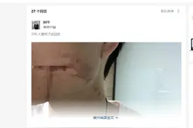 26岁小伙拔智齿出血不止10天后死亡，医生称血液里全是细菌图片