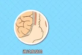 别拿疝气不当事，小洞不补吃大苦图片