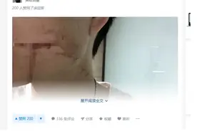 长沙26岁男子拔牙十多天后离世｜拔牙后出血，你会区分正常与非正常吗图片