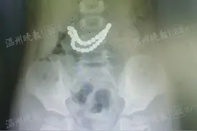 紧急提醒！当心这种珠子！温州一3岁男孩误食32颗，造成消化道4处穿孔图片