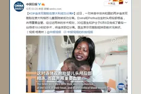 2岁连体双胞胎在意大利成功分离！此前头颅后部相连共用血管图片