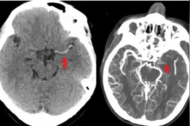 31岁年轻妈妈突发半身不遂 医生还原可怕的家庭真相图片