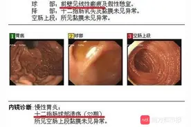 一根牙签的人体“漫游”误吞一个，牙签游走到了腹腔里图片