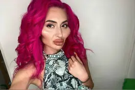 网红沉迷整容，自己在家给脸上打针…结果现在整成这样?图片