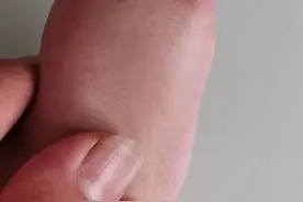 邯郸一幼儿小脚趾畸形，医生手术失误致截肢图片
