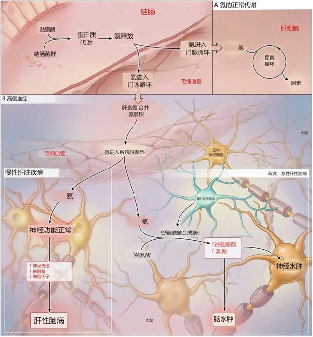 除了肝硬化，这些原因也可导致高氨血症性脑病！｜临床必备