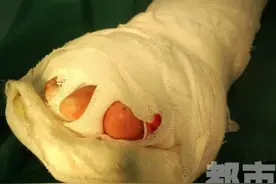 小心！陕西6岁男童大拇脚趾被夹断，这个意外隐患几乎每家孩子都有图片