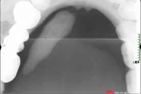 活久见！广州男子口里掏出“子弹头”竟是口腔内腺体导管结石图片