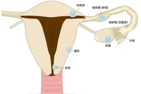 【妇产科普】“要命”的宫外孕，这4类女性一定要当心！图片