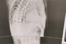 17岁罕见病男孩穿上“螺钉护甲”，扭曲身形一夜变直图片