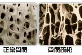 预防骨质疏松，这几点请记住图片
