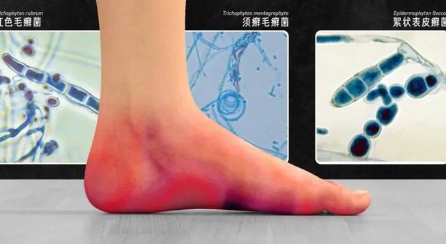 酸爽实验解答为什么你的脚这么臭？