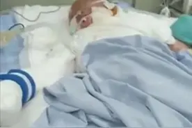 心痛！培训班6个孩子被烧伤！一男孩被送ICU抢救，父母几乎认不出他…图片