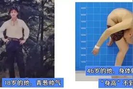 身体被敲断4次，“折叠”20多年的他终于站起来了图片
