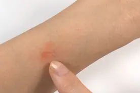 被蚊子咬了太痒难受？教你一招，不用买药，快速止痒图片