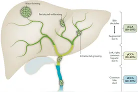 Nature reviews：胆管癌死亡率攀升背景下，这些重点危险因素和治疗方式你掌握了吗？图片
