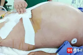 男子连吃一周小龙虾，肚子胀大如西瓜，血都变白了图片