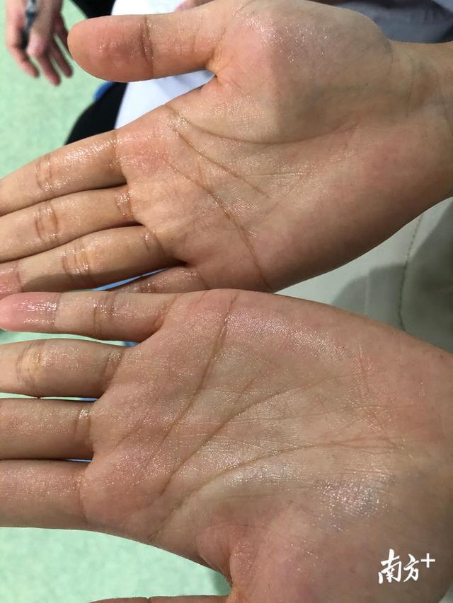 根治手汗疱疹的方法（会滴水的手汗症能根治吗中山医生只需一根针）